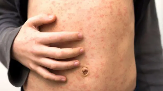 Fast-spreading’ measles outbreak hits several schools in London